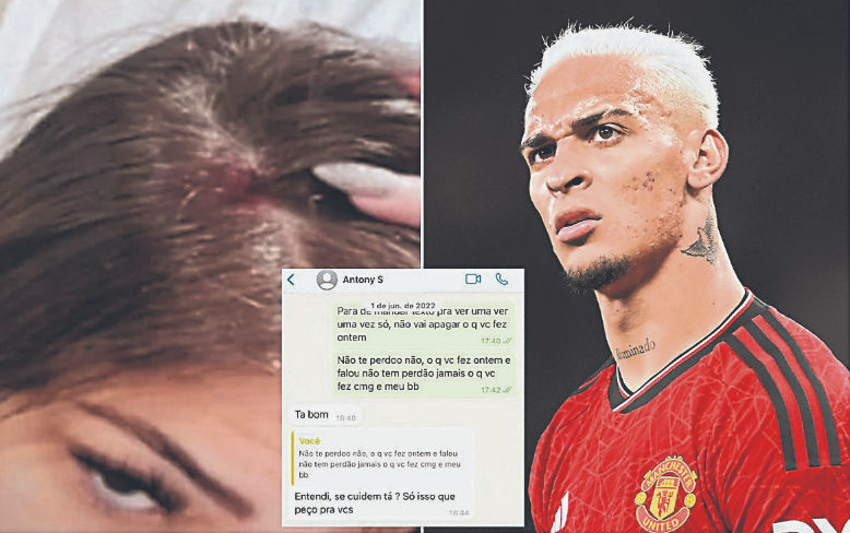 安东尼虐待前女友导致其乳房植入物脱落需缝针处理