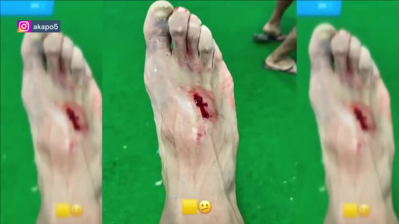 慎点！加的斯球员遭阿扎尔踩到脚面 赛后晒流血伤口照（加的斯vs埃尔切）